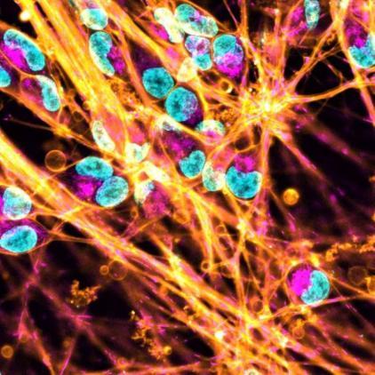 These images are of iPSCs derived from Friedreich's ataxia patients, which have been differentiated into sensory neurons