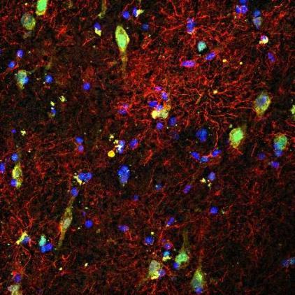 : Anterior cingulate cortex brain tissue from an individual with major depressive disorder stained for astrocytes (red, GFAP), neurons (yellow, NeuN) and FKBP5 (green). Nuclei indicated in blue.